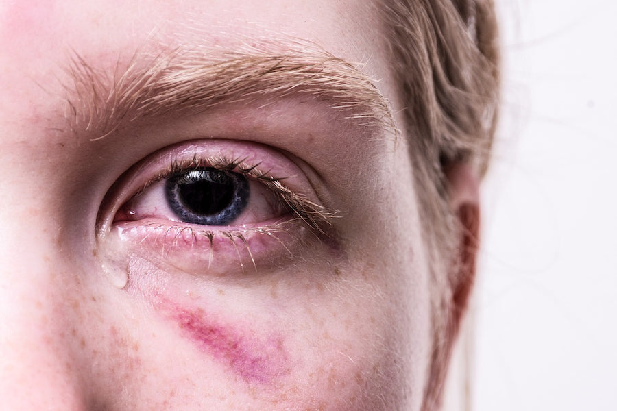 Emotionally Damaging Relationship Will Cause PTSD — Leave As Soon As You Can!